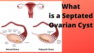 What is a Septated Ovarian Cyst [upl. by Stewardson834]