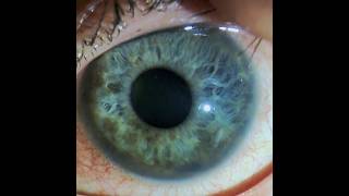 Uncontrolled IOP in an Eye with a Ciliary Body Melanoma 4 Months after Brachytherapy [upl. by Maighdiln342]