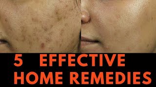 5 EFFECTIVE Home Remedies for Skin Pigmentation Brown Spots and freckles [upl. by Ytte]