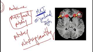 Video 217 Overview of Demyelinating Disorders Clinical Features Diagnostics and Risk Factors [upl. by Nadab266]