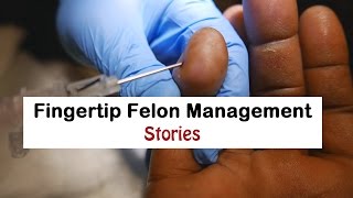 Fingertip Felon Management Stories [upl. by Aidole]