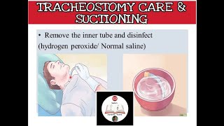 Closed suction of a tracheostomy tube [upl. by Larson695]