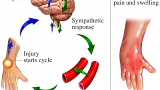 Complex Regional Pain Syndrome CRPS [upl. by Garnett]