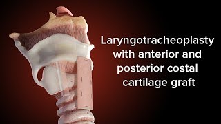 Medical Animation Anterior and Posterior Cricoid Split  Cincinnati Childrens [upl. by Hyacintha]