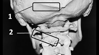 What is Occiptial Neuralgia [upl. by Bore]