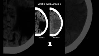 Old territorial infarct  CT brain Acute CT Brain Chronic ischaemia 60 radiologychannel007 [upl. by Sibylla]