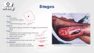 Pressure Ulcers NCLEX® Review  NRSNGacademycom [upl. by Virgy448]