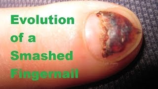 Evolution of a Smashed Fingernail [upl. by Elleynod309]