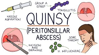 Understanding Quinsy Peritonsillar Abscess [upl. by Nagaek]