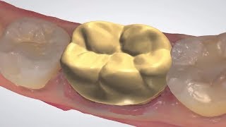 3Shape Dental System  Full Anatomical Crown on TRIOS Scan [upl. by Ryder]