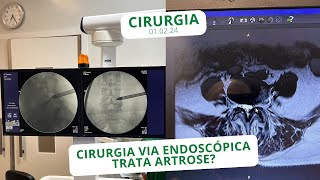 Cirurgia via endoscópica trata artropatia degenerativa mais conhecida como artrose  010224 [upl. by Bueschel]