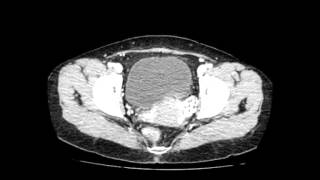 Right Paraduodenal Hernia [upl. by Haya]