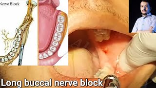 Local Anesthesia Long Buccal Nerve Block Technique Mandibular Anesthesia techniques dentistry [upl. by Vachell449]