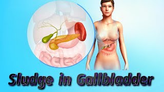 Sludge in Gallbladder Symptoms [upl. by Safire161]