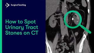 Urinary Tract Stones  How do we Diagnose them on CT Scans [upl. by Etteve]