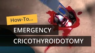 Emergency Cricothyroidotomy using CricKey [upl. by Kidder]