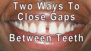 How to Close Gaps Between Teeth [upl. by Behka]