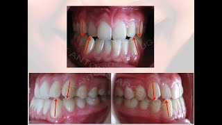 Tratamiento Maloclusion CLASE III  CAMUFLAJE CLASE III [upl. by Mayfield165]