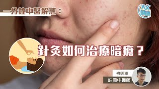 中醫解惑：針灸如何治療暗瘡？ [upl. by Jody]