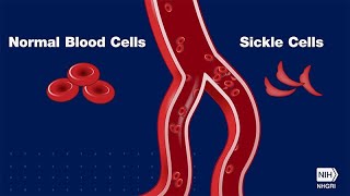 Mayo Clinic Minute Sickle cell disease explained [upl. by Eillib]