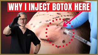 How To Inject Botox Under The Brow  Botox Brow Lift Advice [upl. by Ivens629]