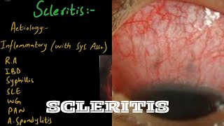 SCLERITIS in easiest way  Part 1 [upl. by Noonberg]