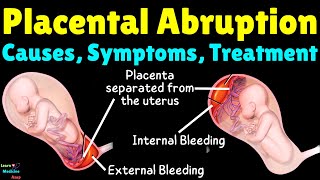 Placental Abruption Causes Symptoms Diagnosis Treatment Complications amp Prevention [upl. by Burford80]