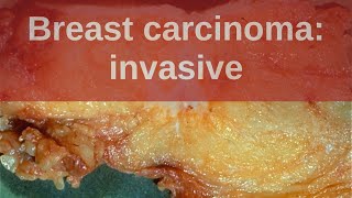 Breast Carcinoma Invasive  Pathology mini tutorial [upl. by Samson]