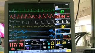 Adenosine induced transient cardiac arrest [upl. by Einal732]