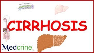 LIVER CIRRHOSIS causespathophysiologyfeaturesdiagnosistreatment [upl. by Nodnnarb]