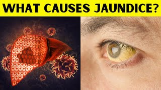 Uncover the Untold Reasons Behind Jaundice Hidden Causes of Jaundice You Need to Know [upl. by Rudelson]