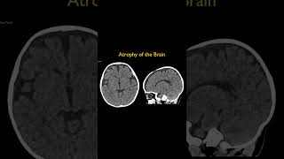 Atrophy of the Brain [upl. by Zalea113]