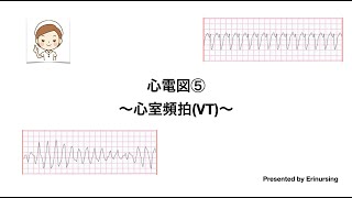 心電図⑤｜心室頻拍VT [upl. by Franni]