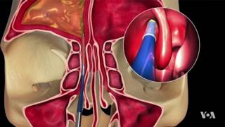 NonInvasive Procedure Is Proving Successful in Sinusitis Treatment [upl. by Garlan]