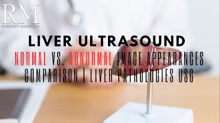 Liver Ultrasound Normal vs Abnormal Image Appearances Comparison  Liver Pathologies USG [upl. by Daile]