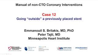 Case 12 PCI Manual quotNeoluminalquot revascularization [upl. by Tommie910]