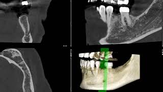 Implant 20 CBCT analysis [upl. by Zampardi]