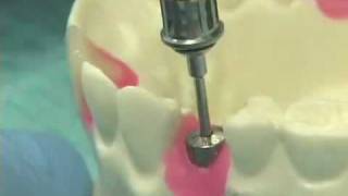 Placing Implant Abutments [upl. by Phillip465]