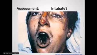 Inhalational Injuries quotEM in 5quot [upl. by Nesbitt]