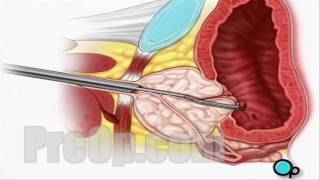 TURP Transurethral Resection Prostate Surgery patient education series [upl. by Notna]