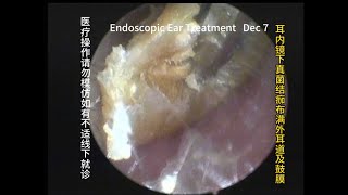 Appearance and treatment methods of fungal otitis externa 20231207 [upl. by Michele]