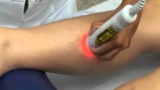 Tratamento de Celulite Edematosa por meio de Laser Ibramed [upl. by Anelrac]