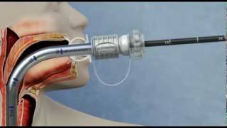 Food bolus retrieval using the GUARDUS™ Overtube and TALON™ Grasping Device [upl. by Giuliana]