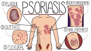 Psoriasis Explained Clearly  Including Types and Treatment [upl. by Obla]