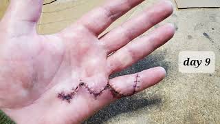 hand surgery healing time lapse 36 days in 90 seconds [upl. by Eissahc]