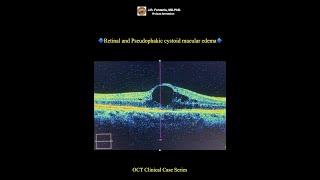 Pseudophakic cystoid macular edema [upl. by Airednaxela976]