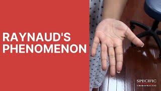 Raynauds Syndrome Phenomenon HELPED by Dr Suh Gonstead Chiropractic NYC [upl. by Gio324]