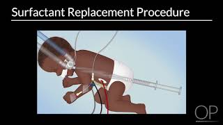 Surfactant Replacement in Neonates by B Walsh  OPENPediatrics [upl. by Stilwell]