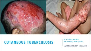 SKINCUTANEOUS TUBERCULOSIS BY DR ABRAHAM TB ulcers funny viralvideo education dermatology [upl. by Imelda]