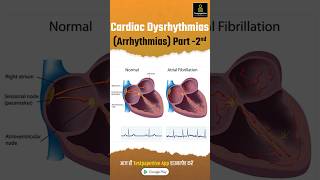 Cardiac Dysrhythmias Arrhythmia Part2  Types of Cardiac Arrhythmia Cardiac Dysrhythmias [upl. by Dominus]